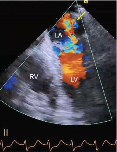 anteroseptal hypokinesis